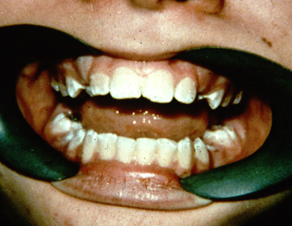 deciduous teeth wikipedia