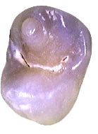 Dens_Evaginatus_Mx_2nd_Premolar_BC.jpg