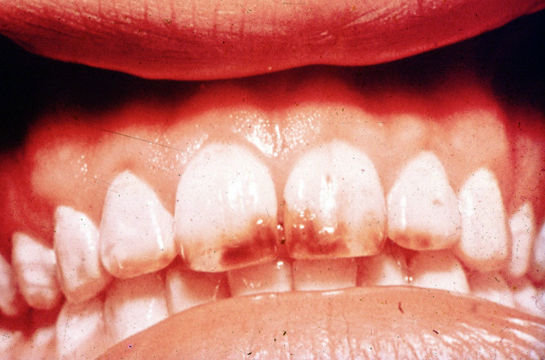 Fluorosis_2_UM.jpg