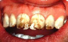 Fluorosis_UM.jpg