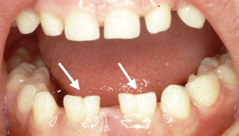 Abnormalites in Shape of Teeth