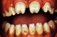 Hutchinsons_incisors_UM.jpg