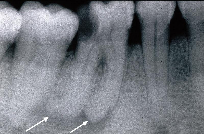 Hypercementosis_4.6_UM_Arrows.jpg