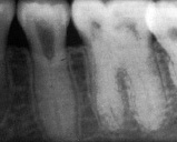 dentin_dysplasia_PA2_UM.jpg