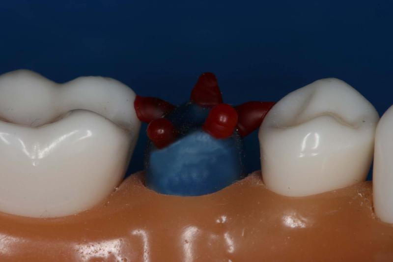 Md2ndPremolarStep2Li.jpg