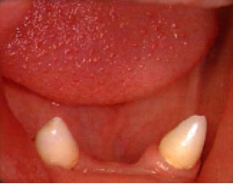 Abnormal Numbers of Teeth